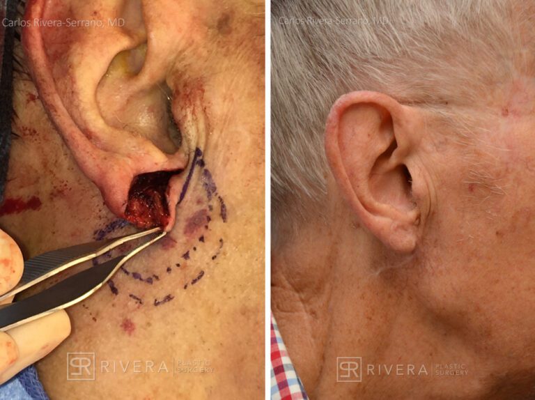 Right earlobe reconstruction from skin cancer removal with cheek flap (2 stages) - Man - Case 17303 - Before and after - Lateral view
