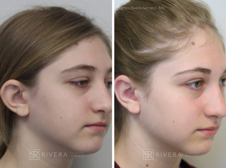 Ear surgery (otoplasty) woman - Otoplasty - Before and after case 2 - Lateral View