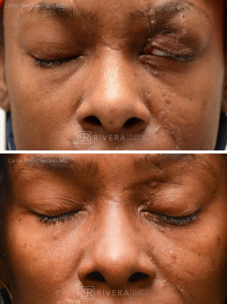 Left upper eyelid retraction with exposed globe correction with Z Plasty - Woman - Case 15402 - Before and after - Frontal view