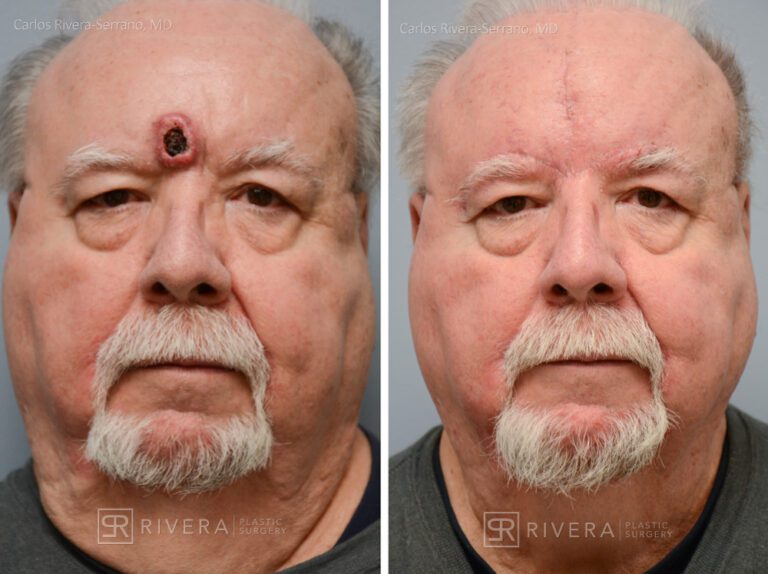 Forehead reconstruction from skin cancer removal with A-T Advancement flaps - Man - Case 15401 - Before and after - Frontal view