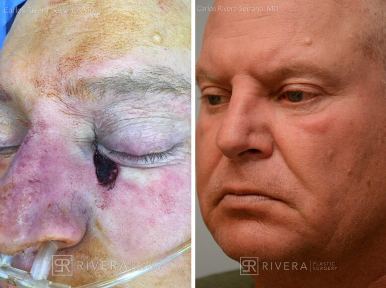 Left medial lower eyelid reconstruction from skin cancer removal with Upper to Lower eyelid switch pedicle flap (2 stages) - Man - Case 15411 - Before and after - Oblique view