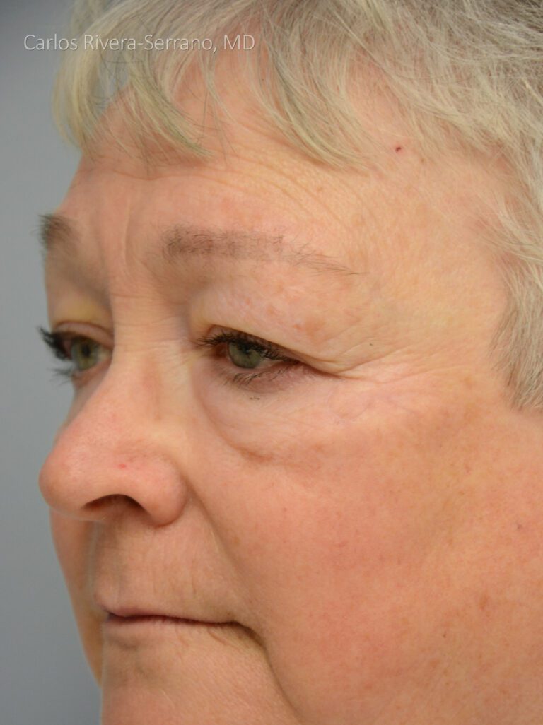 Left lateral canthus - lower eyelid reconstruction with Rombic flap - Woman - Case 15412 - Postoperative - Oblique view