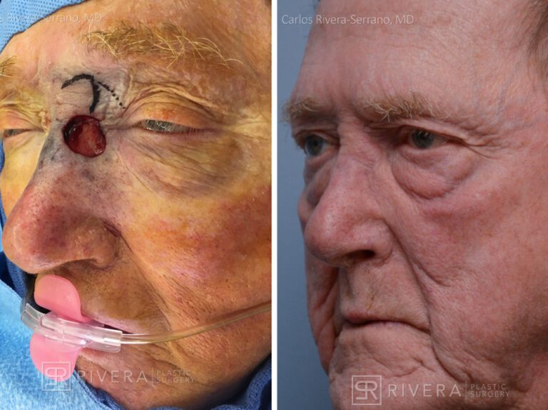 Left medial canthus - nasal reconstruction with Rombic flap - Man - Case 15413 - Before and after - Oblique view