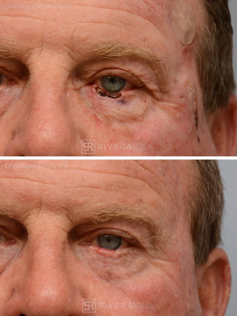 Left lower eyelid reconstruction from skin cancer with Hughes tarsoconjunctival flap & skin advancement flap - Man - Case 15403 - Before and after - Frontal view