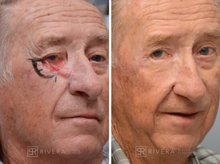 Right lower eyelid reconstruction from skin cancer removal with cervicofacial flap - Man - Case 15404 - Before and after - Oblique view