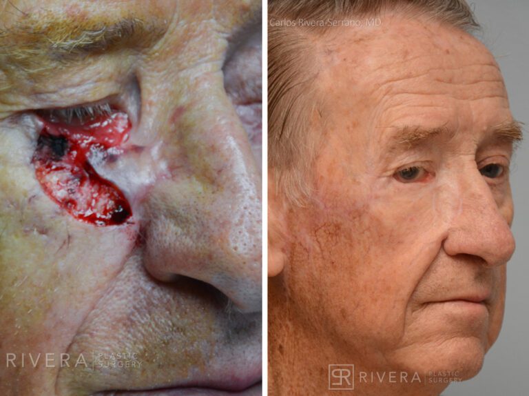 Right lower eyelid reconstruction from skin cancer removal with cervicofacial flap - Man - Case 15404 - Before and after - Oblique view