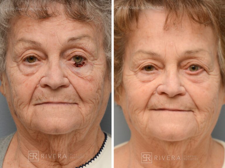 Left lower eyelid reconstruction from skin cancer with Hughes tarsoconjunctival flap & skin graft - Woman - Case 15405 - Before and after - Frontal view