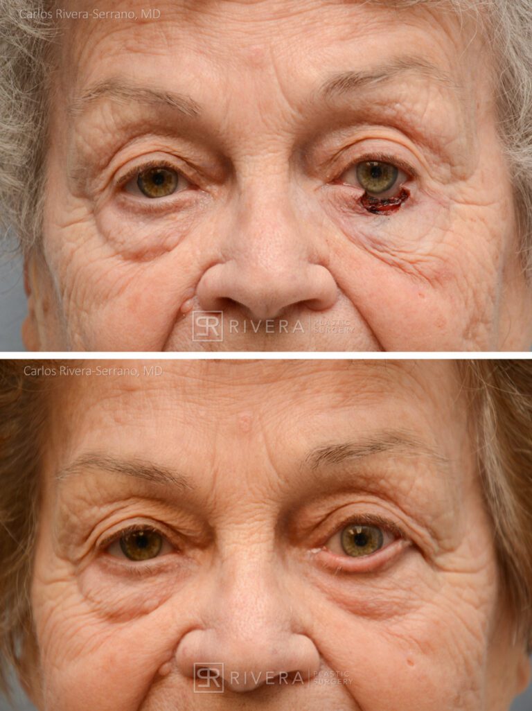 Left lower eyelid reconstruction from skin cancer with Hughes tarsoconjunctival flap & skin graft - Woman - Case 15405 - Before and after - Frontal view