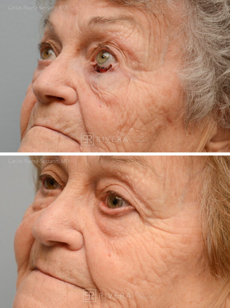 Left lower eyelid reconstruction from skin cancer with Hughes tarsoconjunctival flap & skin graft - Woman - Case 15405 - Before and after - Oblique view