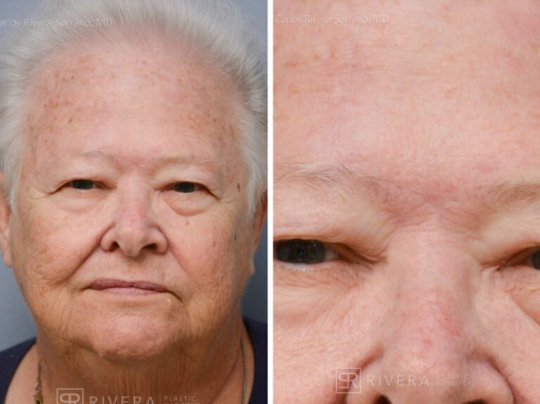 Forehead reconstruction from skin cancer removal with Burow's Triangle Displacement flap - Woman - Case 15406 - Before and after - Frontal view