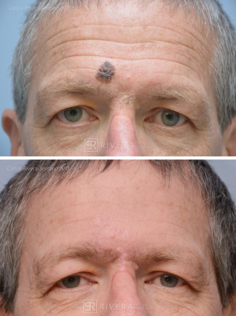 Forehead reconstruction from melanocitic patch removal with Burow's Triangle Displacement flap - Man - Case 15407 - Before and after - Frontal view