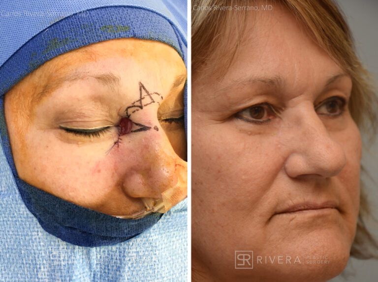 Right medial canthus reconstruction from skin cancer removal with Bilobed rotational flap - Woman - Case 15408 - Before and after - Oblique view