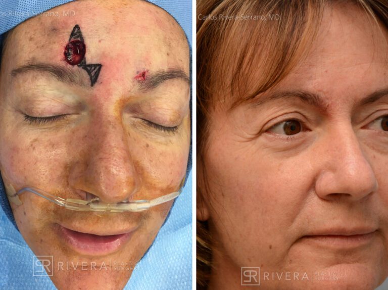 Forehead reconstruction from skin cancer removal with Burow's Triangle Displacement flap - Woman - Case 15410 - Before and after - Oblique view