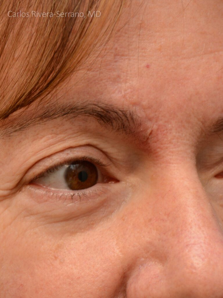 eyelidperiocularreconstruction case9.1 dr carlos rivera serrano