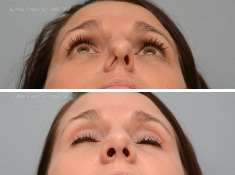 Breathing crooked nose surgery in female patient - Functional nasal surgery - Nose surgery (Rhinoplasty) - Before and after case 1 - Inferior view