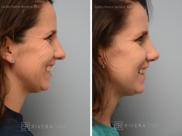 Breathing crooked nose surgery in female patient - Functional nasal surgery - Nose surgery (Rhinoplasty) - Before and after case 1 - Profile view