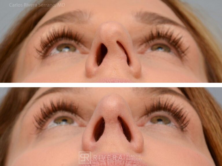 Breathing crooked nose surgery in female patient - Functional nasal surgery - Nose surgery (Rhinoplasty) - Before and after case 2 - Inferior view