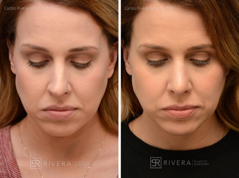 Breathing crooked nose surgery in female patient - Functional nasal surgery - Nose surgery (Rhinoplasty) - Before and after case 2 - Superior view