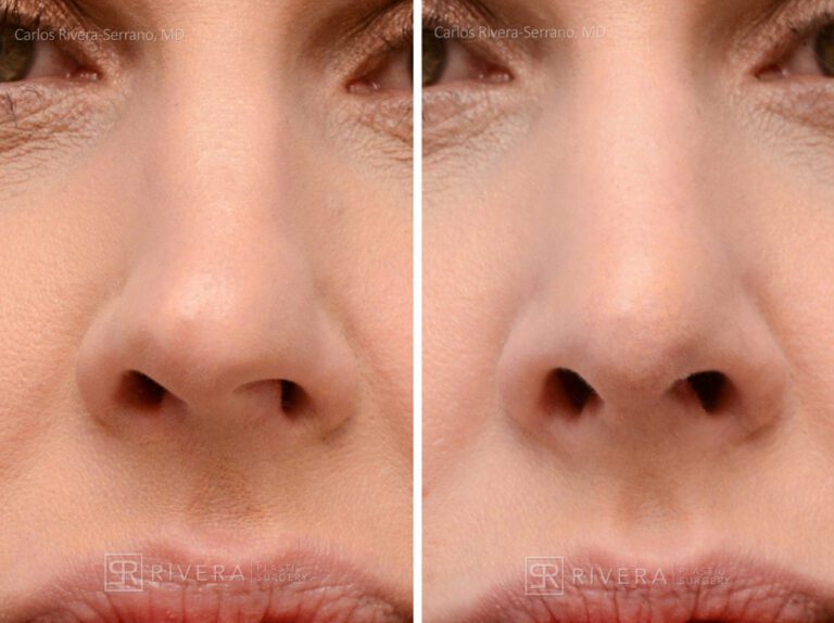 Breathing crooked nose surgery in female patient - Functional nasal surgery - Nose surgery (Rhinoplasty) - Before and after case 2 - Zoomed frontal view