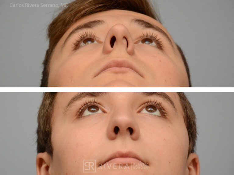 Breathing crooked nose surgery in male patient - Functional nasal surgery - Nose surgery (Rhinoplasty) - Before and after case 3 - Inferior view