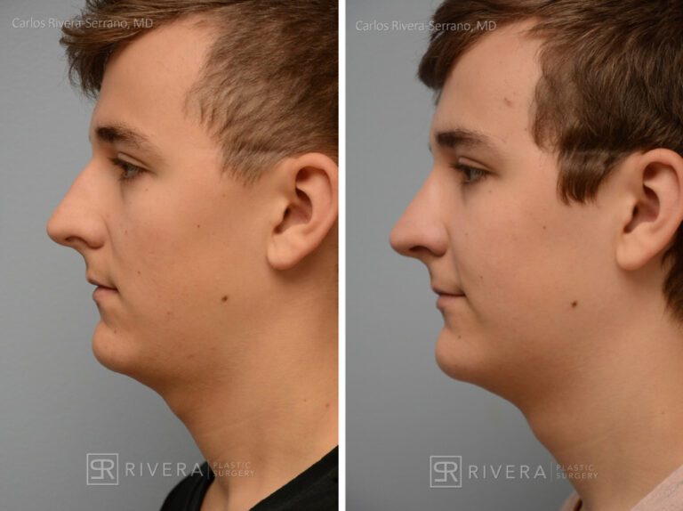 Breathing crooked nose surgery in male patient - Functional nasal surgery - Nose surgery (Rhinoplasty) - Before and after case 3 - Profile view
