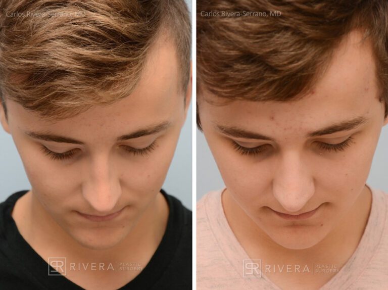 Breathing crooked nose surgery in male patient - Functional nasal surgery - Nose surgery (Rhinoplasty) - Before and after case 3 - Superior view