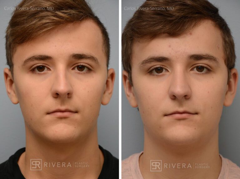 Breathing crooked nose surgery in male patient - Functional nasal surgery - Nose surgery (Rhinoplasty) - Before and after case 3 - Fronta view