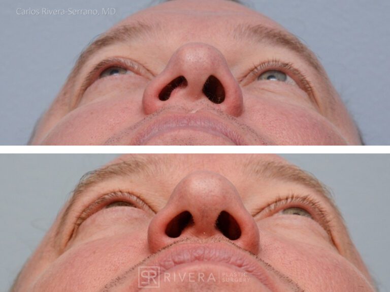 Breathing crooked nose surgery in male patient - Functional nasal surgery - Nose surgery (Rhinoplasty) - Before and after case 4 - Inferior view