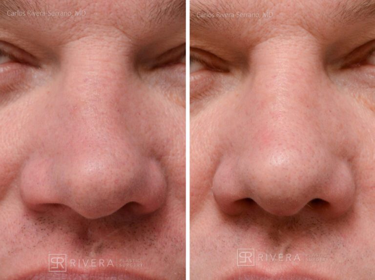 Breathing crooked nose surgery in male patient - Functional nasal surgery - Nose surgery (Rhinoplasty) - Before and after case 4 - Zoomed frontal view