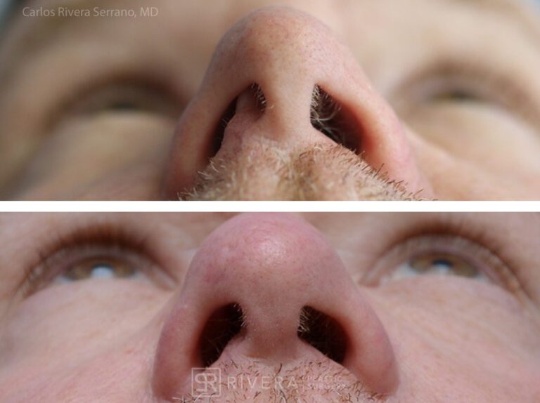 Breathing crooked nose surgery in male patient - Functional nasal surgery - Nose surgery (Rhinoplasty) - Before and after case 5 - Inferior view