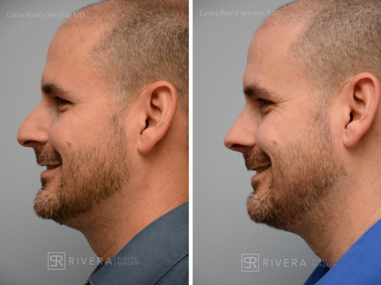 Breathing crooked nose surgery in male patient - Functional nasal surgery - Nose surgery (Rhinoplasty) - Before and after case 6 - Profile view