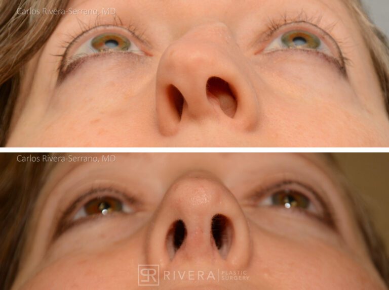 Breathing crooked nose surgery in female patient - Functional nasal surgery - Nose surgery (Rhinoplasty) - Before and after case 7 - Inferior view