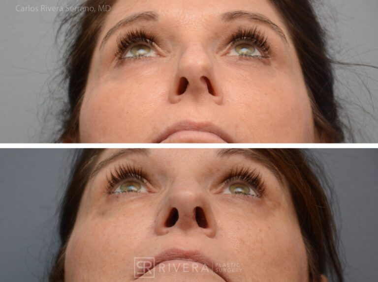 Breathing crooked nose surgery in female patient - Functional nasal surgery - Nose surgery (Rhinoplasty) - Before and after case 8 - Inferior view