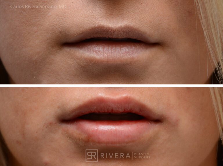 Lip enhancement surgery woman - Lip filler - Before and after case 1 - Frontal view