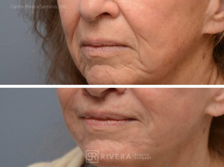 Lip lift surgery woman - Lip lift - Before and after case 1 - Lateral view