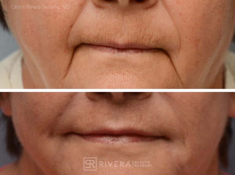Lip lift surgery woman - Lip lift - Before and after case 5 - Frontal view