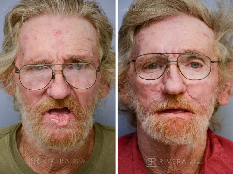 Total lower lip reconstruction from advanced lip cancer with Bernard - Webster lip reconstruction technique - Man - Case 19201 - Before and after - Frontal view