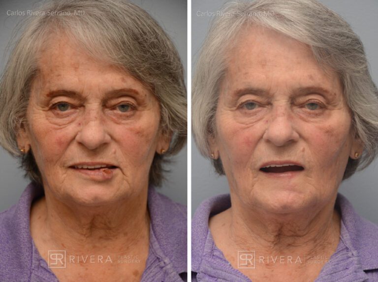 Lower lip reconstruction from skin cancer removal with local Advancement flaps - Woman - Case 19203 - Before and after - Frontal view