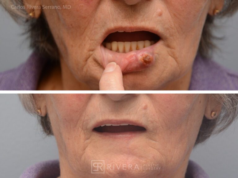 Lower lip reconstruction from skin cancer removal with local Advancement flaps - Woman - Case 19203 - Before and after - Frontal view