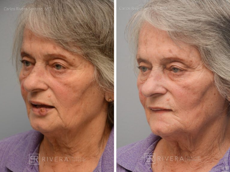 Lower lip reconstruction from skin cancer removal with local Advancement flaps - Woman - Case 19203 - Before and after - Oblique view