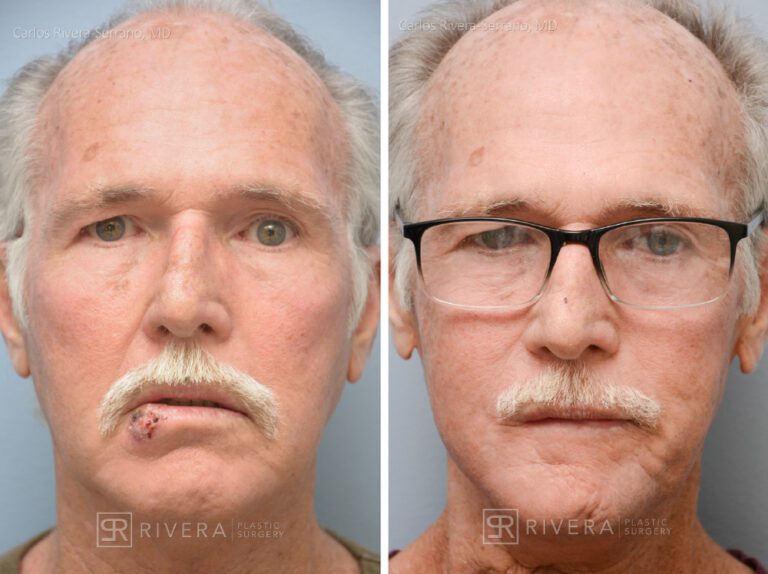 Lower lip reconstruction from skin cancer removal with local Advancement flaps - Man - Case 19204 - Before and after - Frontal view