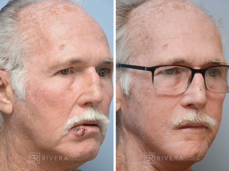 Lower lip reconstruction from skin cancer removal with local Advancement flaps - Man - Case 19204 - Before and after - Frontal view