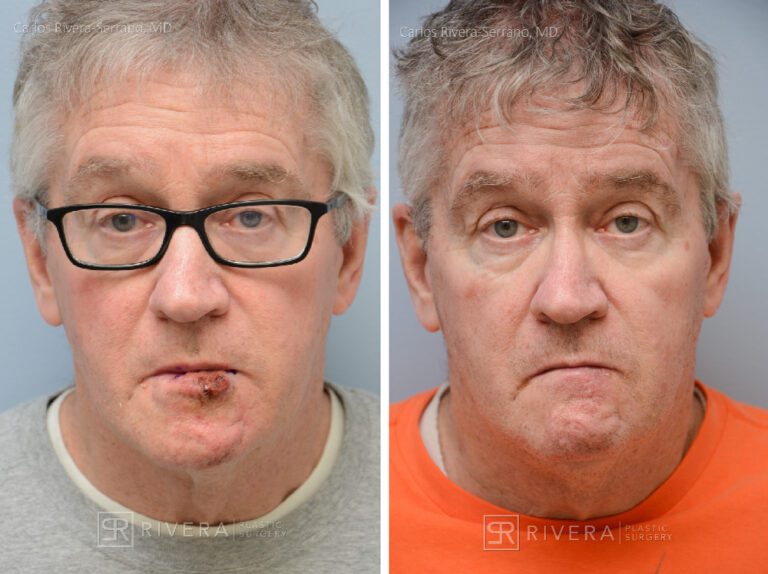 Lower lip reconstruction from skin cancer removal with local Advancement flaps - Man - Case 19207 - Before and after - Frontal view