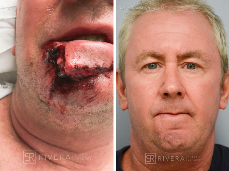 Upper lip reconstruction from complex traumatic injury with primary closure - Man - Case 19209 - Before and after - Frontal view