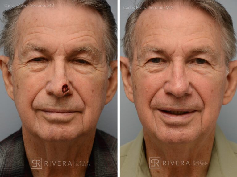 Nose reconstruction from skin cancer removal with Bilobed Rotational flap - Man - Case 16501 - Before and after - Frontal view