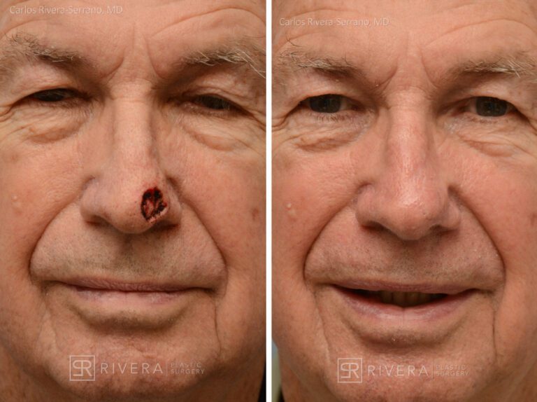 Nose reconstruction from skin cancer removal with Bilobed Rotational flap - Man - Case 16501 - Before and after - Frontal view