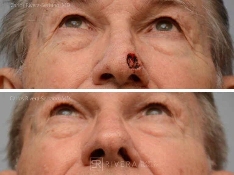 Nose reconstruction from skin cancer removal with Bilobed Rotational flap - Man - Case 16501 - Before and after - Inferior view