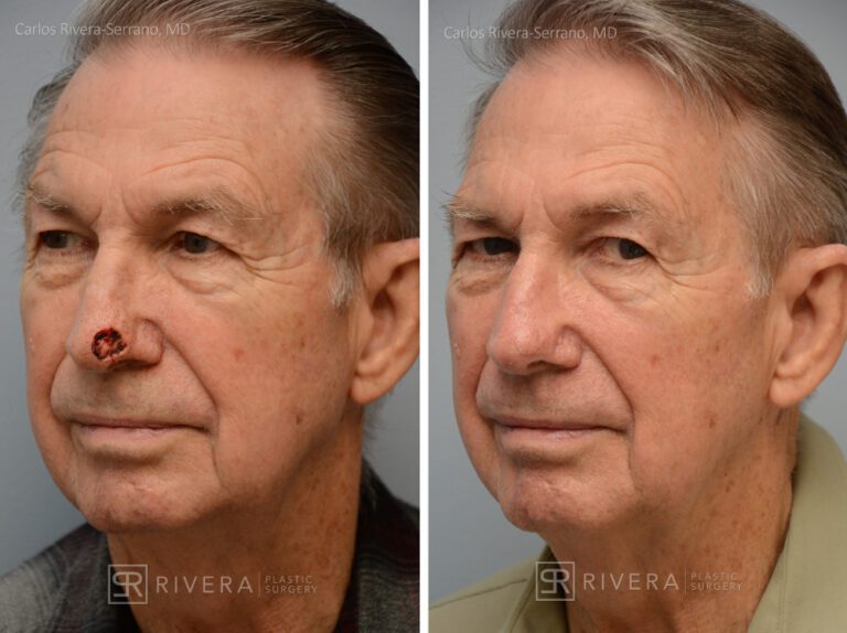 Nose reconstruction from skin cancer removal with Bilobed Rotational flap - Man - Case 16501 - Before and after - Oblique view