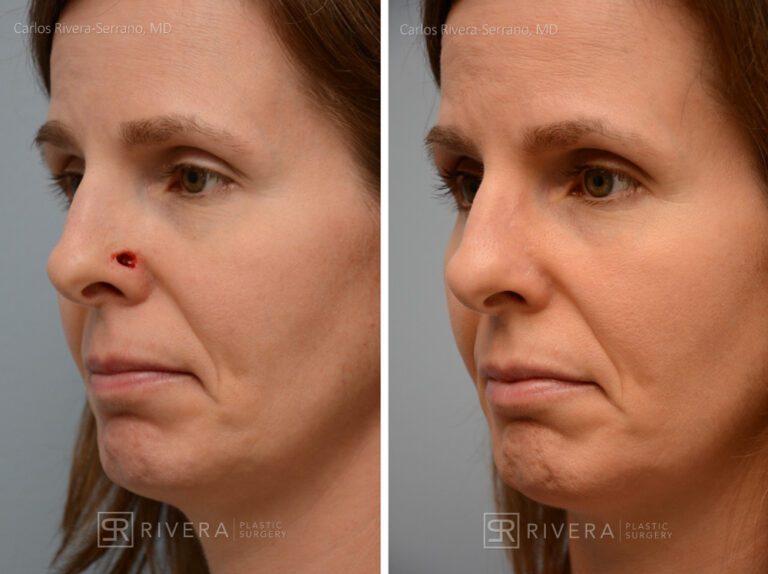 Nose reconstruction from skin cancer removal with Bilobed Rotational flap - Woman - Case 16510 - Before and after - Oblique view