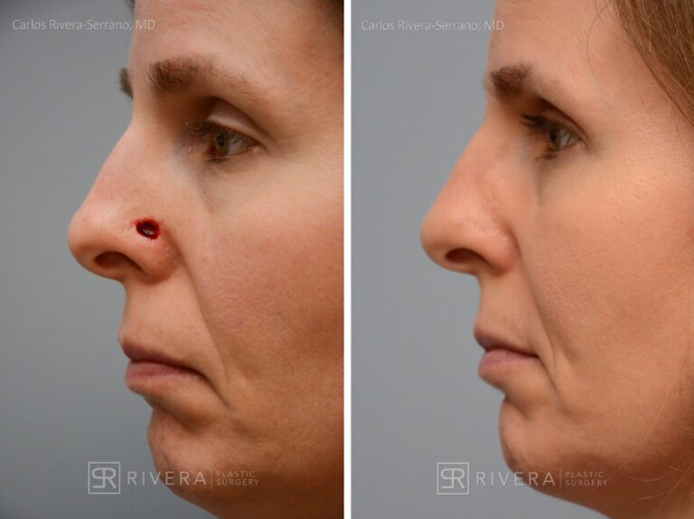 Nose reconstruction from skin cancer removal with Bilobed Rotational flap - Woman - Case 16510 - Before and after - Lateral view